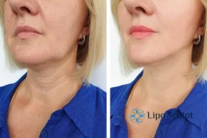 Double chin before and after Hi-Fu treatment 4 Book your double chin treatment Cirencester today! We are here to help!