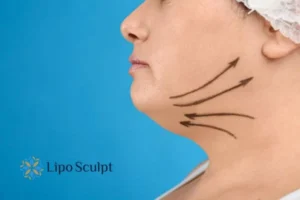 Double chin before and after Hi-Fu treatment 3 Boost your confidence with a Double chin treatment Cirencester