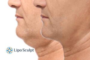 Double chin before and after Hi-Fu treatment 2 Double chin treatment Cirencester from Lipo Sculpt - feel more confident today!