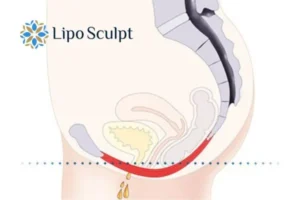 Pelvic Floor Chair Therapy 1 Pelvic Floor Chair Therapy Cirencester to treat incontinence.