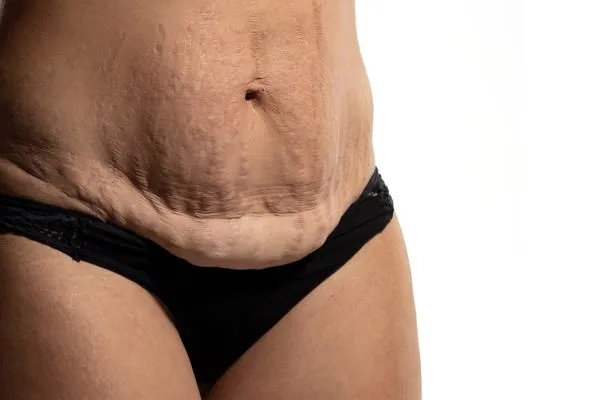 Lost the Weight but Not the Loose Skin? 1 image of womans stomach after weight loss showing loose skin Cirencester
